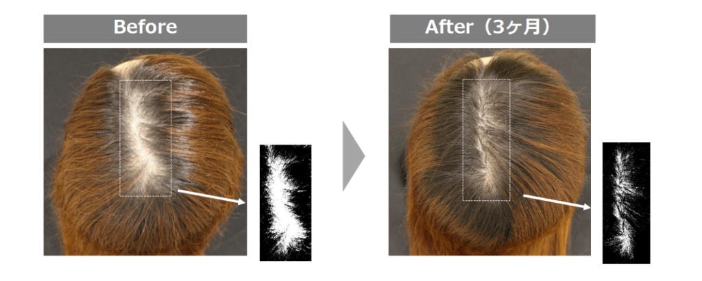 DEMI DOを3ヶ月使用した透けた頭皮部分の改善イメージ画像